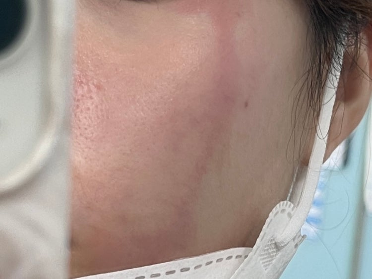 얼굴 피부 붉은 발진 또는 두드러기 원인이 뭔가요ㅠㅠ : 지식iN