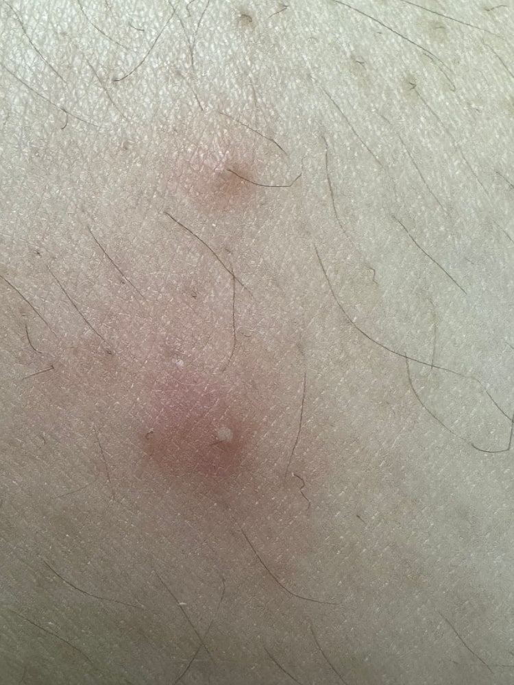 다리 여드름 종기 염증 : 지식iN