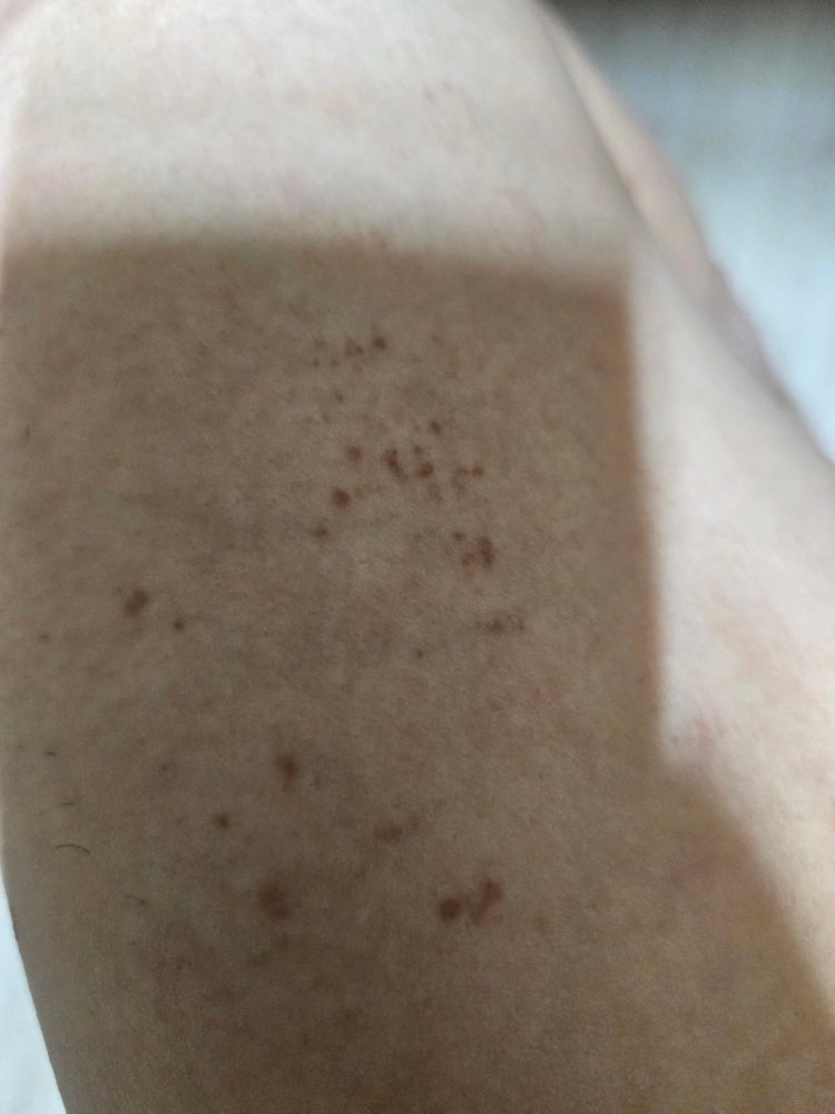 피부에 이런 까만색 돌기가 점점 늘어나는데 뭔가요? : 지식iN