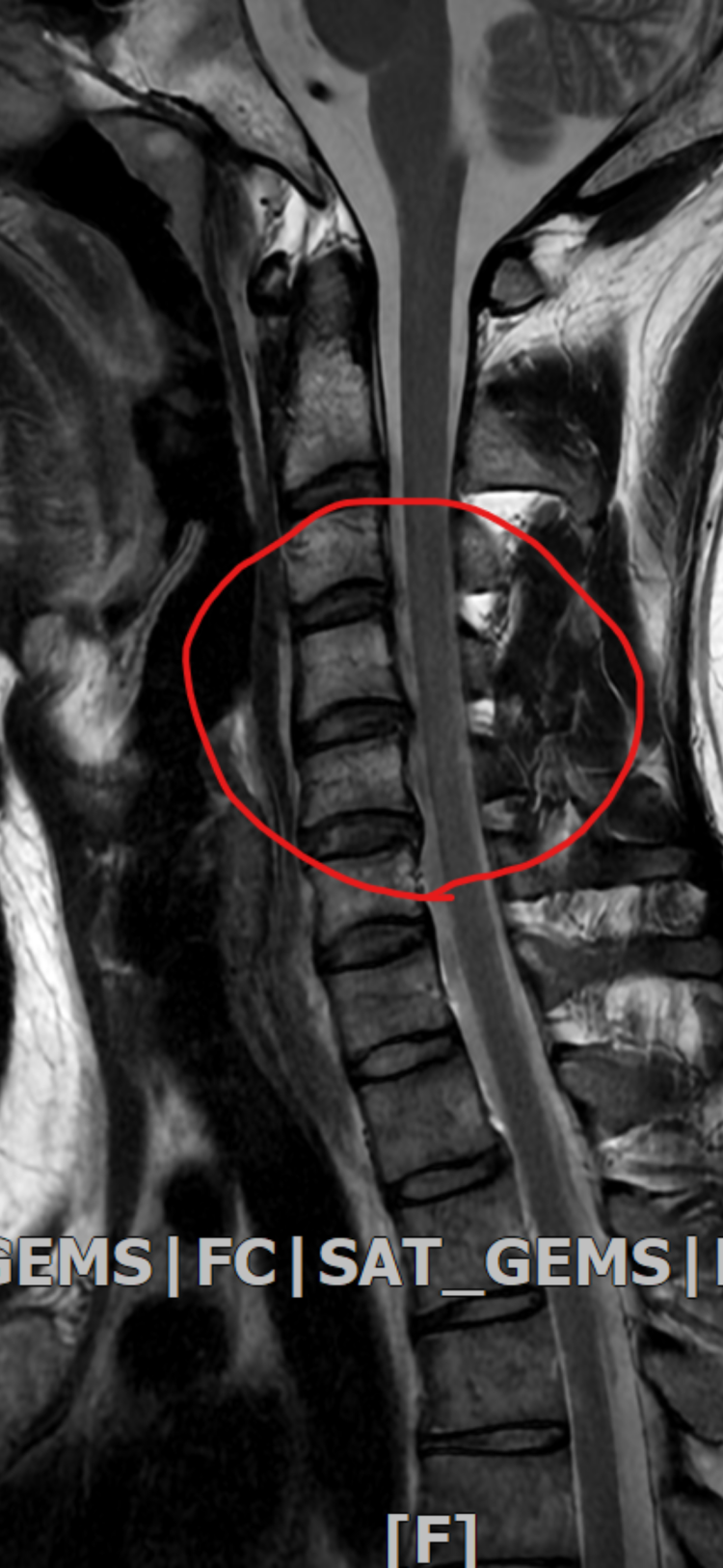 경추 mri 결과 질문(경추척수증 or 목디스크) : 지식iN